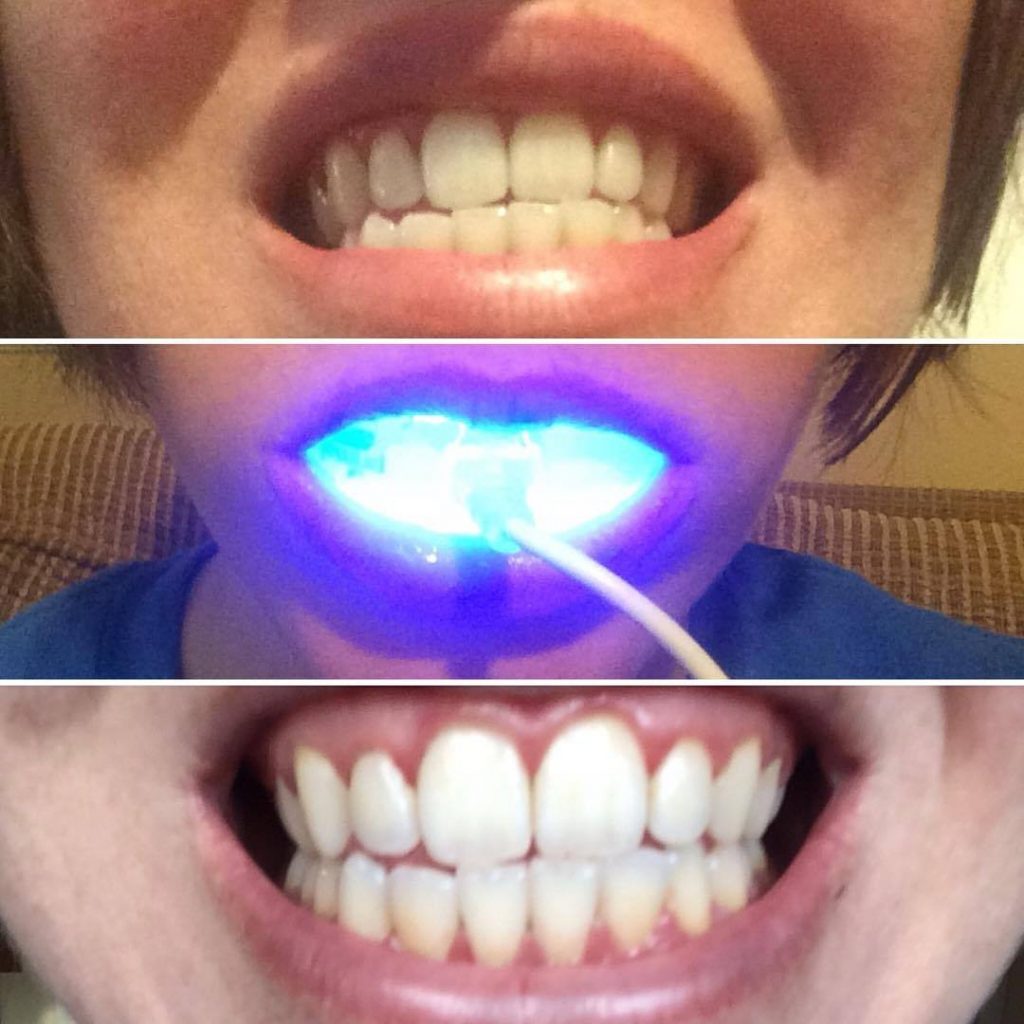 Before and After working of DiamondSmile