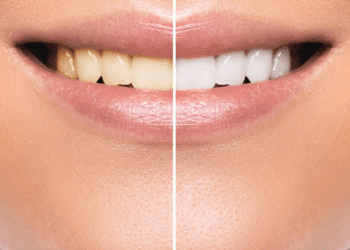 Benefits of a Teeth Whitening