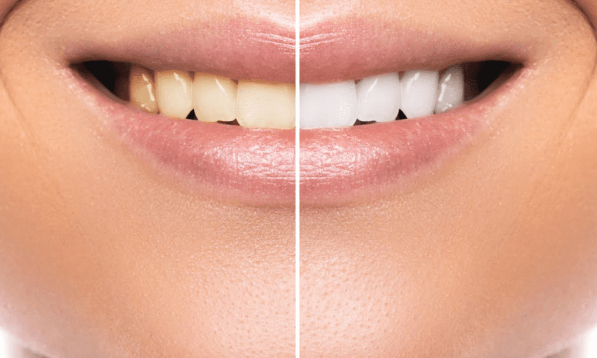 Benefits Of A Teeth Whitening