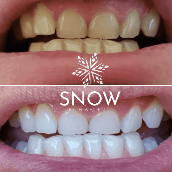 Before and after using Snow Teeth Whitening Kit
