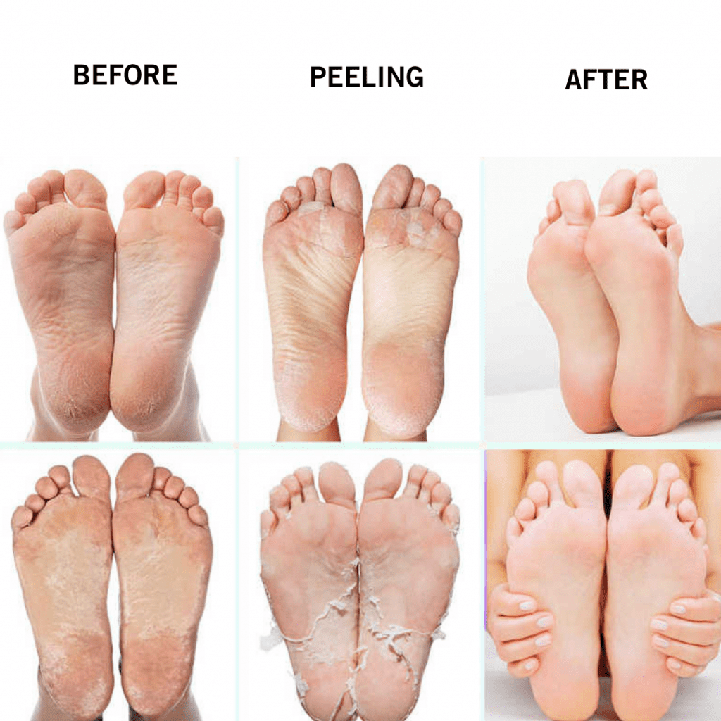 Foot Peel Mask Before and After