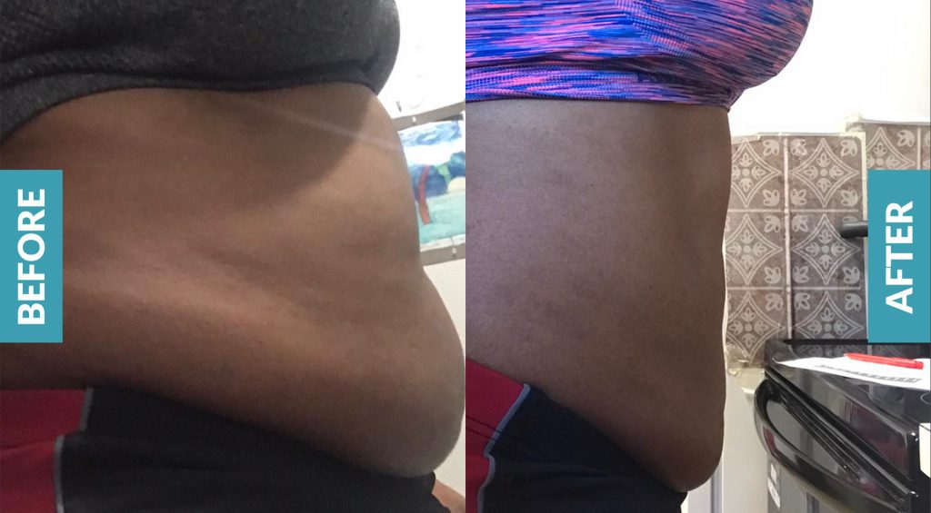 Before and After using Isavera Fat Freezing System