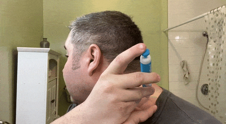 A customer using Smootag Wart Remover